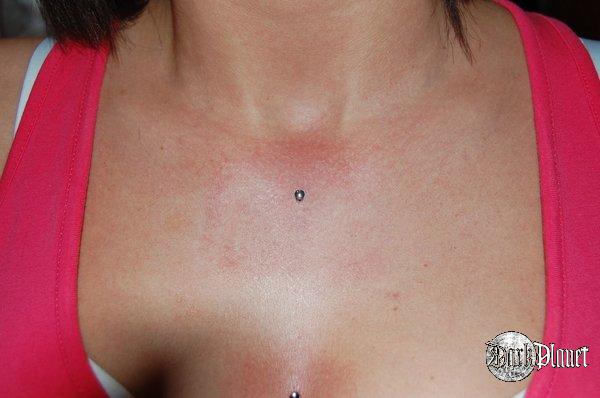 microdermal madison